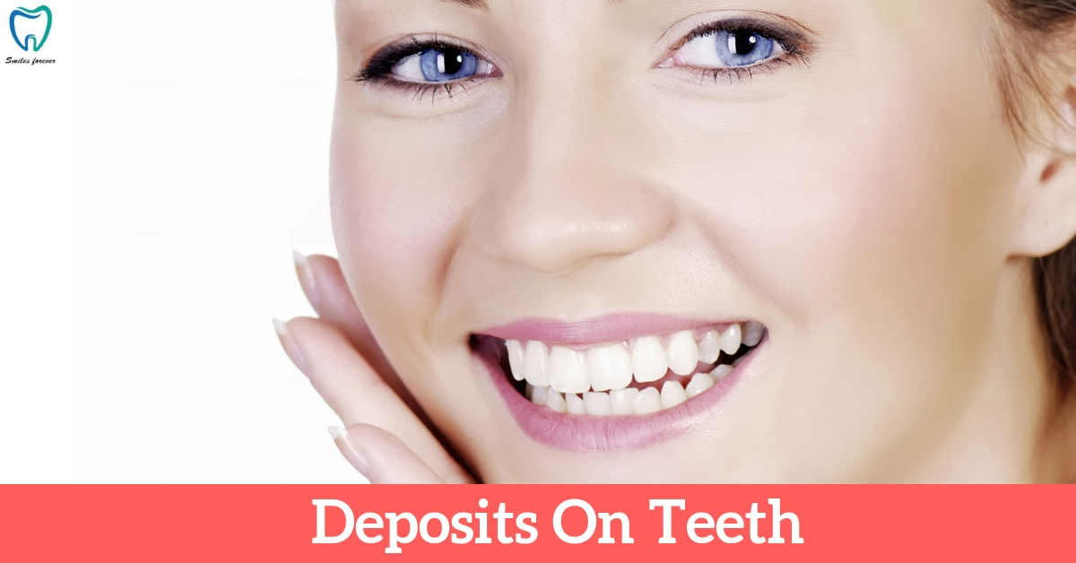 Deposits on teeth | Dentistry In Bellandur