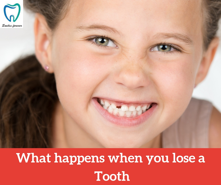 What Happens When You Lose a Tooth | Best Dental Treatment in Bellandur
