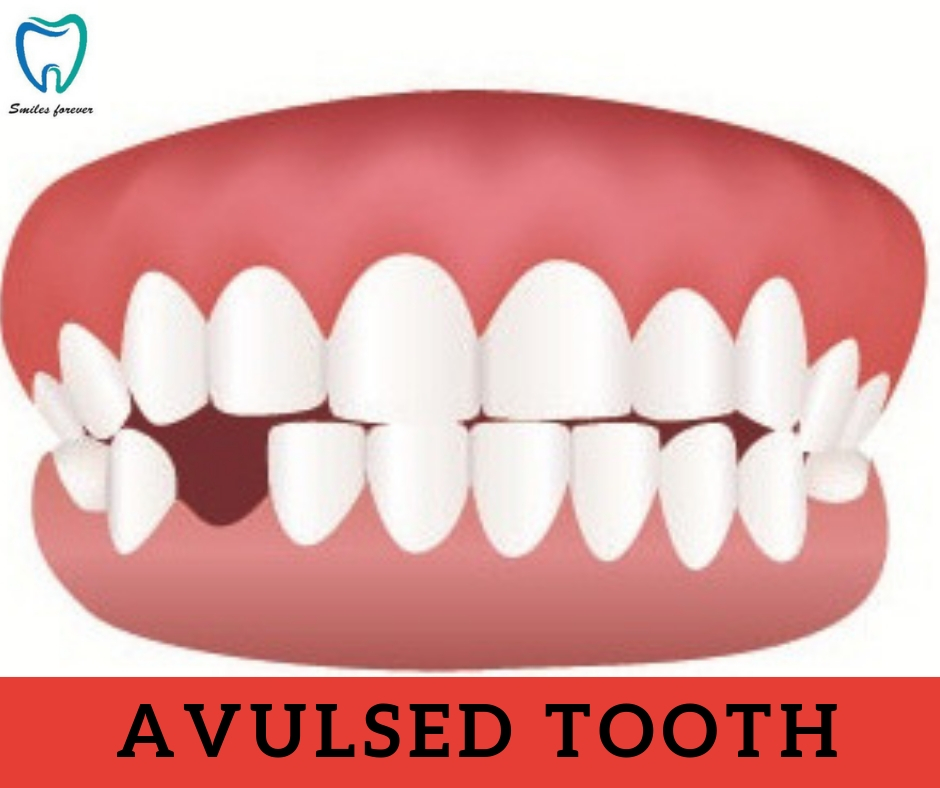 AVULSED TOOTH | Top 10 Dental Clinic in Bangalore