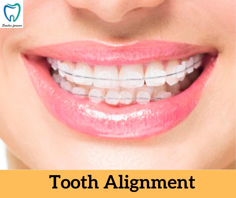 Tooth alignment | Best Orthodontic Treatment in Bangalore