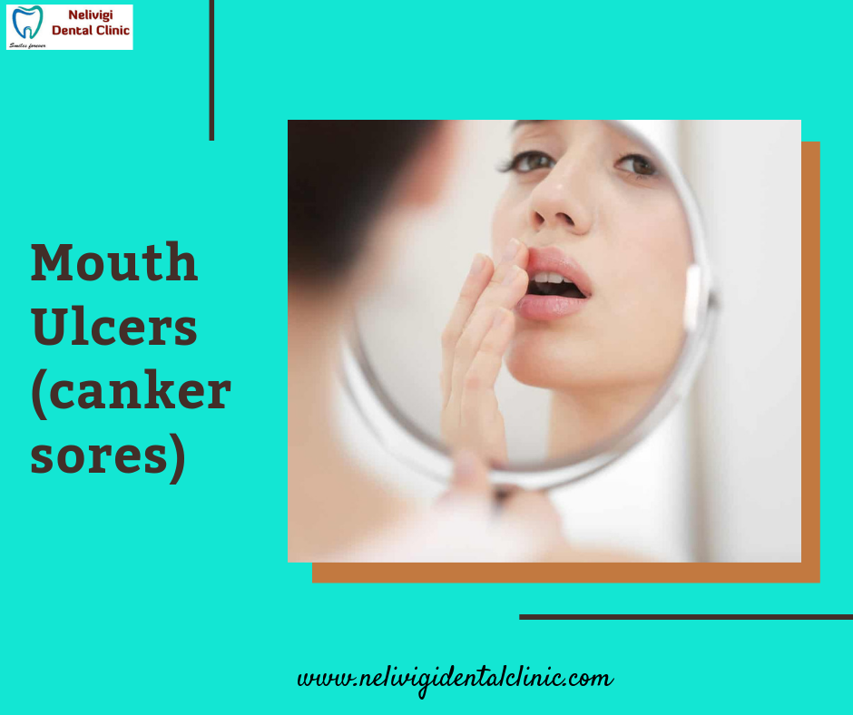 Canker Sores Treatment | Mouth Ulcer Treatment in Bellandur | Bangalore