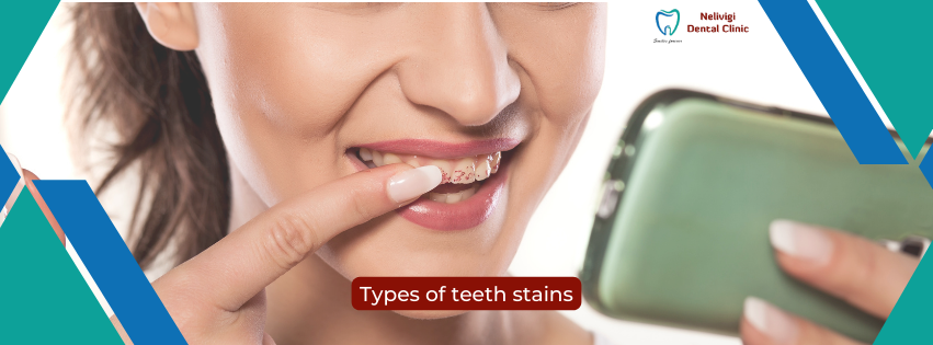Types of Tooth Stains | Dental Clinic near me in Bellandur | Nelivigi Dental Clinic