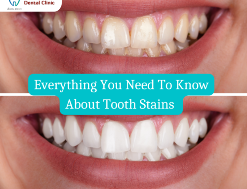 Tooth Stains – Everything You Need To Know About Tooth Stains