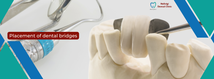 Placement of dental bridges