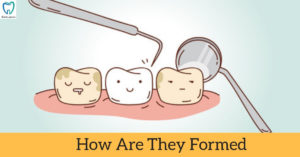 How are they formed | Dentistry In Bellandur
