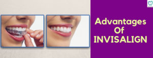 Advantages Of Invisalign | Best Dental Clinic for Invisalign in Bellandur