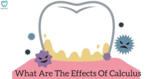 What are the effects of calculus | Dentistry In Bellandur