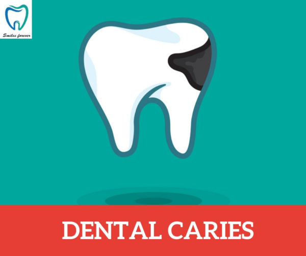 Dental Caries | Dental Caries Treatment in Bellandur