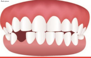 AVULSED TOOTH | Top 10 Dental Clinic in Bangalore