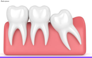 The Wisdom about Wisdom Teeth | Best Wisdom Tooth Extraction in Bangalore