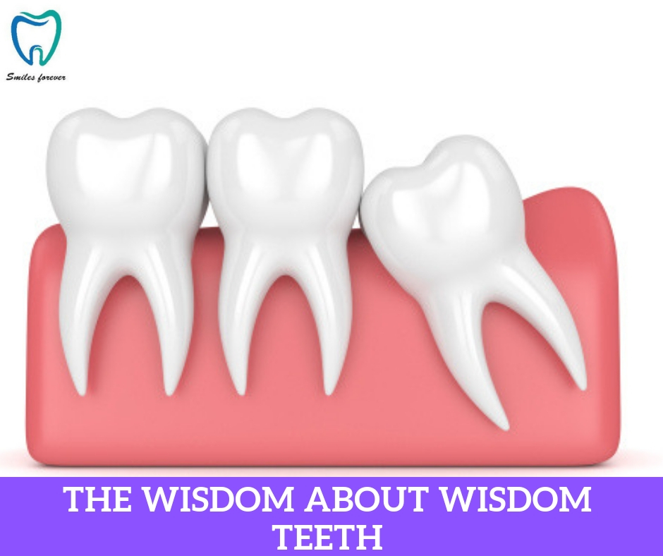The Wisdom about Wisdom Teeth | Best Wisdom Tooth Extraction in Bangalore