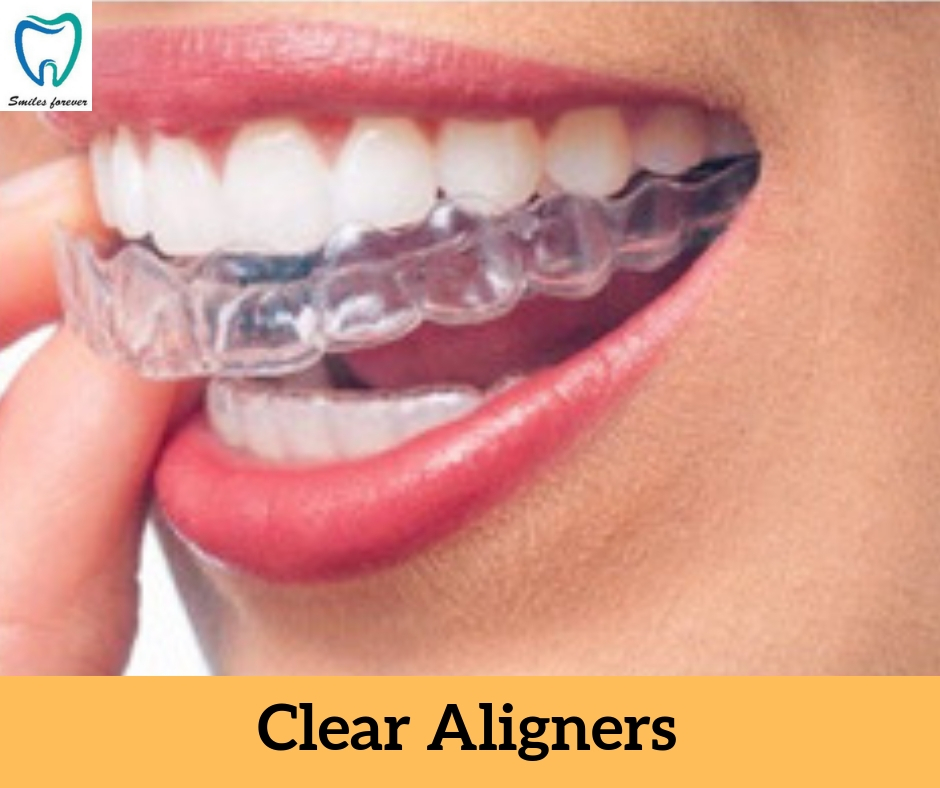 Clear Aligners | Best Orthodontic Treatment in Bellandur 