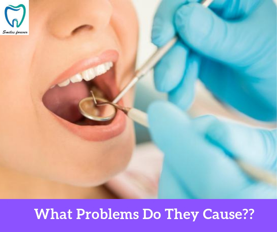 What problems do they cause?? | | Best Wisdom Tooth Extraction in Bangalore 