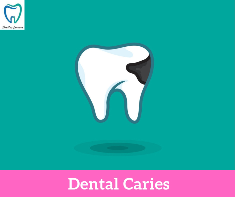 Dental Caries | Best Dental Hospital in Bangalore