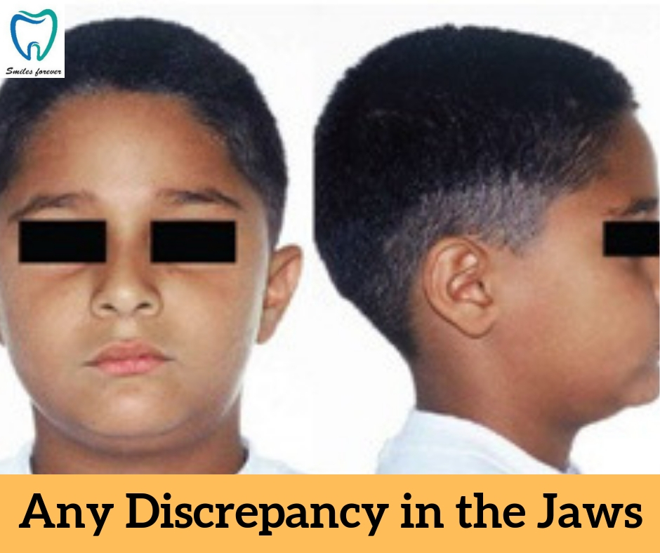 Any Discrepancy in the Jaws | Best Orthodontic Treatment in Bellandur 