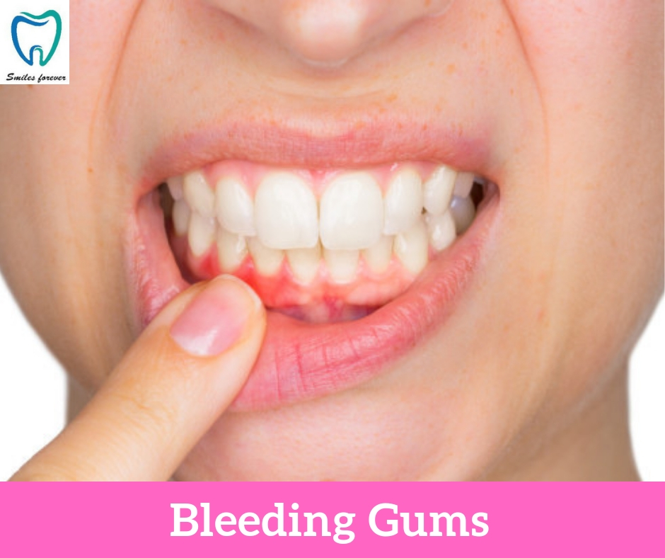 Bleeding Gums | Best Dental Hospital in Bangalore