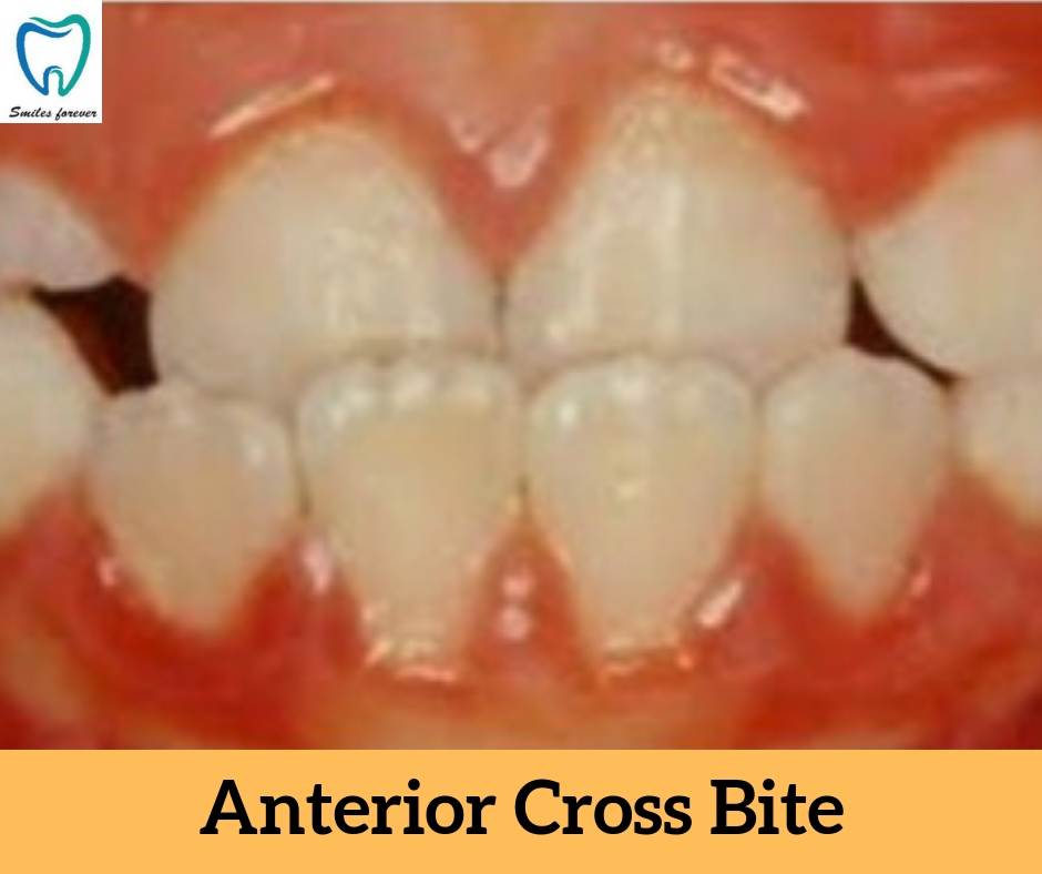 Anterior Cross Bite | Best Orthodontic Treatment in Bellandur 