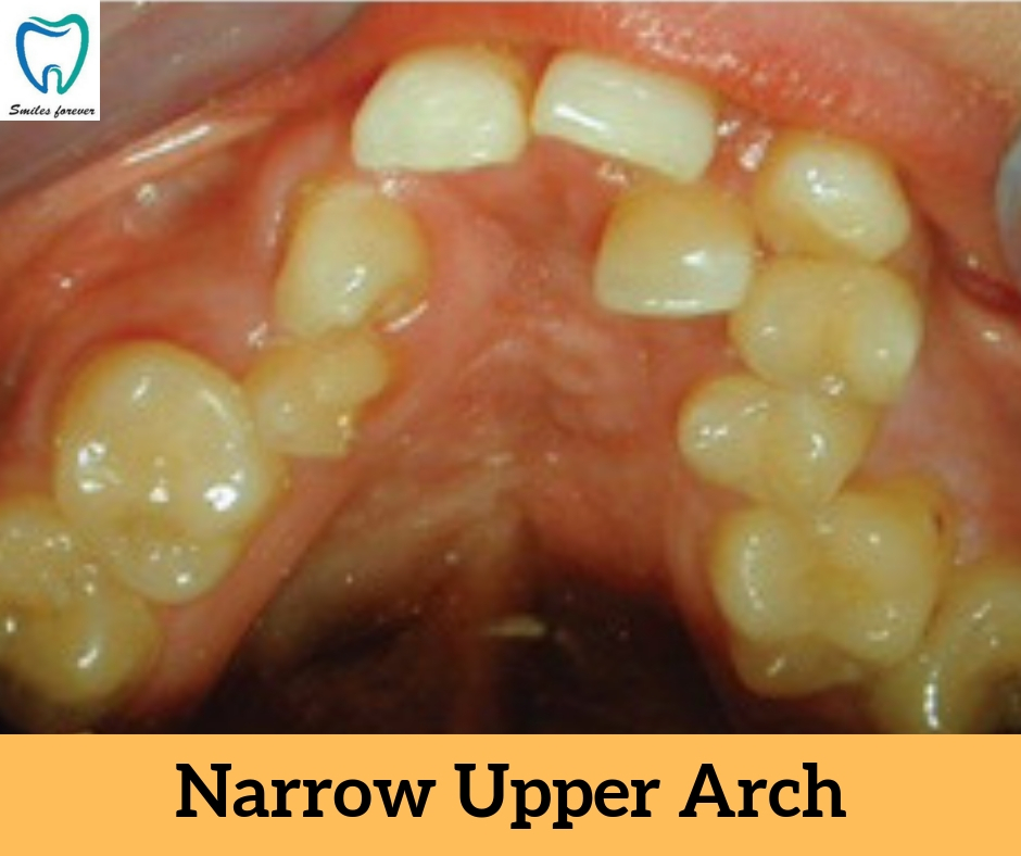 Narrow Upper Arch | Best Orthodontic Treatment in Bellandur 