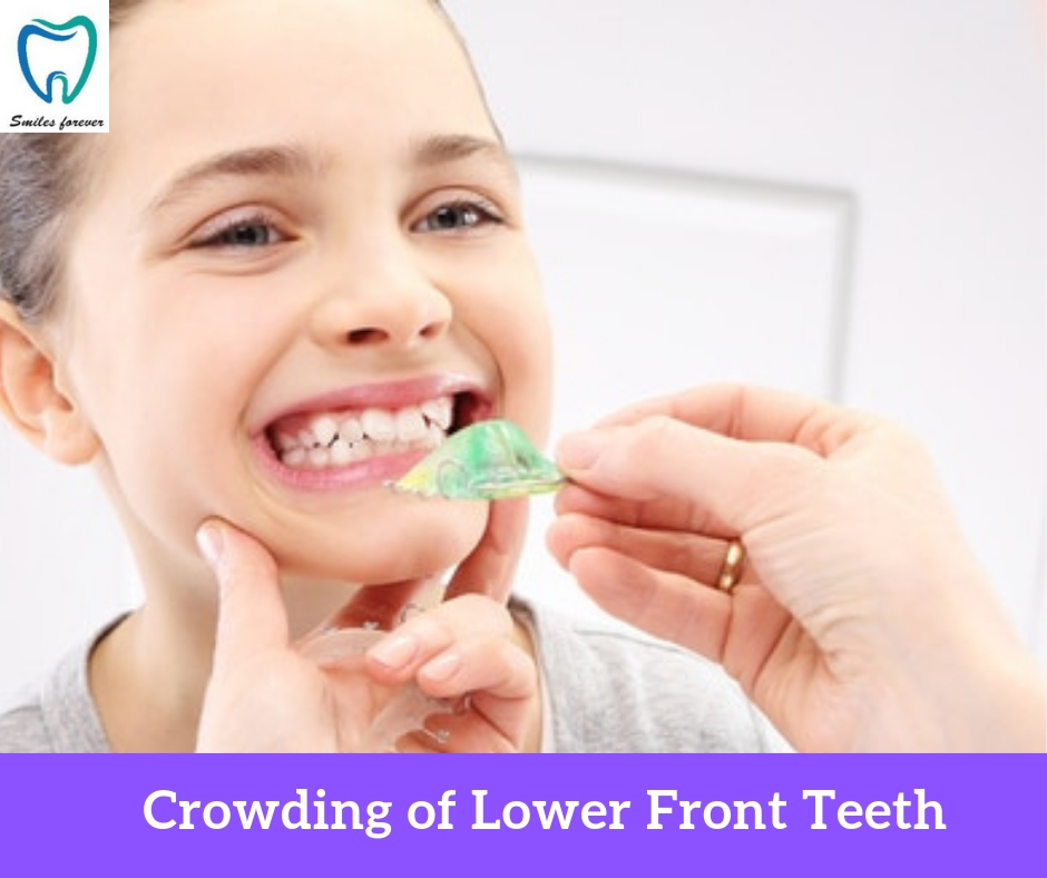 Crowding of Lower Front Teeth | Best Wisdom Tooth Extraction in Bangalore 