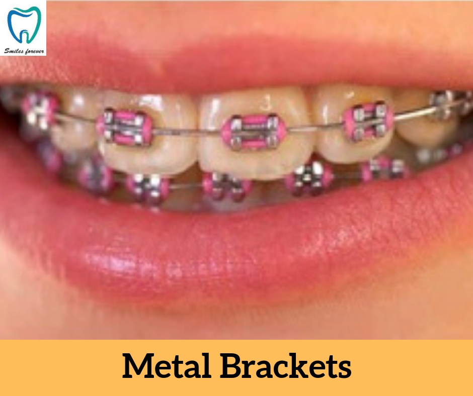 Metal Brackets | Best Orthodontic Treatment in Bellandur 