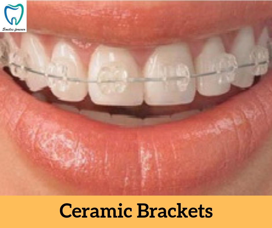 Ceramic Brackets | Best Orthodontic Treatment in Bellandur 