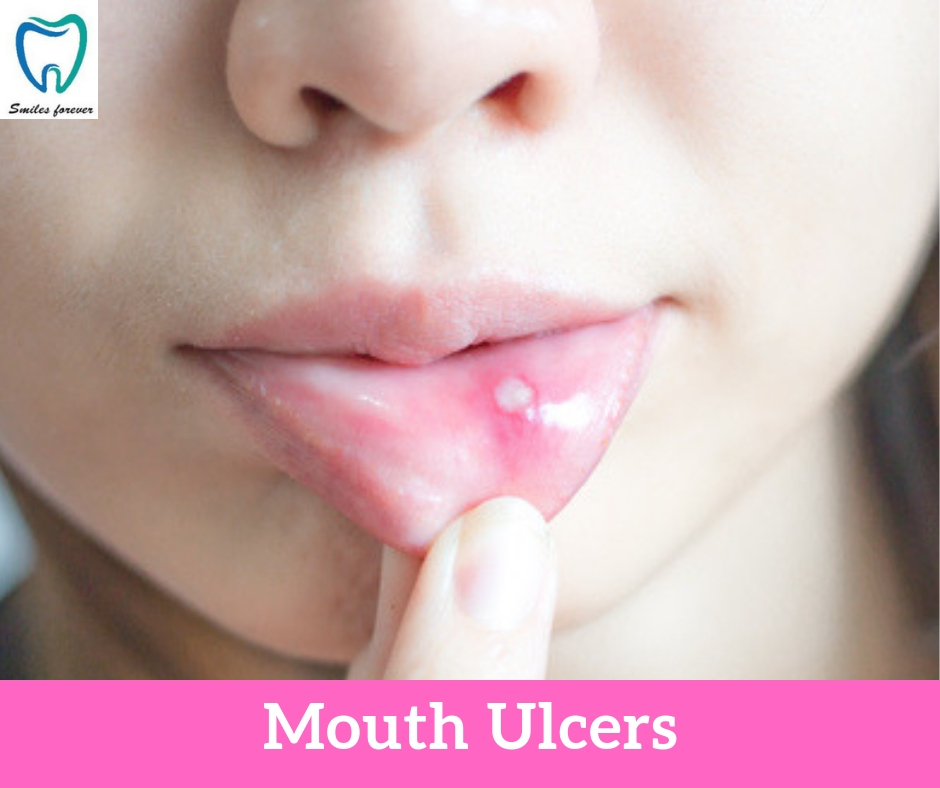 Mouth Ulcers | Best Dental Hospital in Bangalore