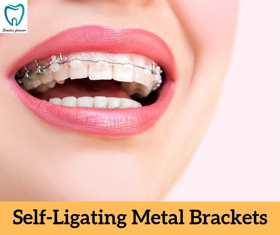 Self-ligating metal brackets | Best Orthodontic Treatment in Bellandur 