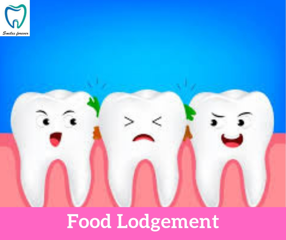 Food Lodgement | Best Dental Hospital in Bangalore