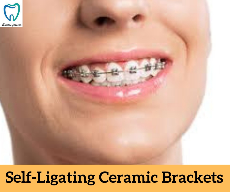 Self-Ligating Ceramic Brackets | Best Orthodontic Treatment in Bellandur 