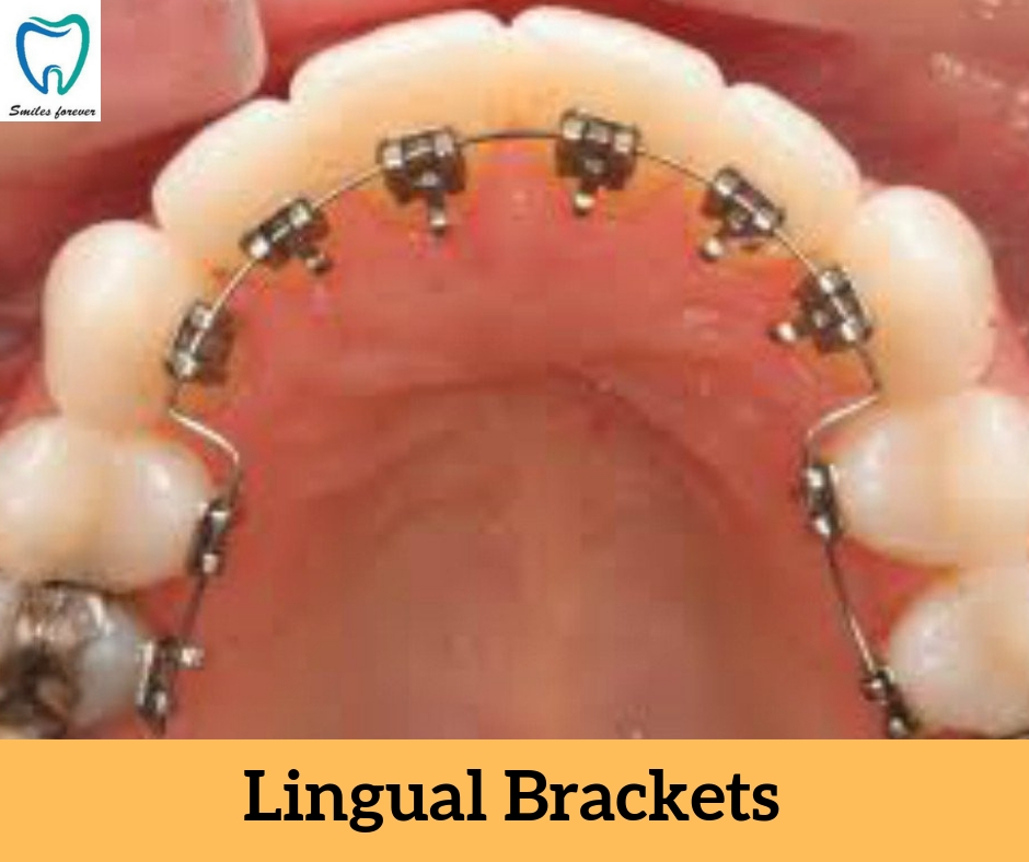 Lingual Brackets | Best Orthodontic Treatment in Bellandur 