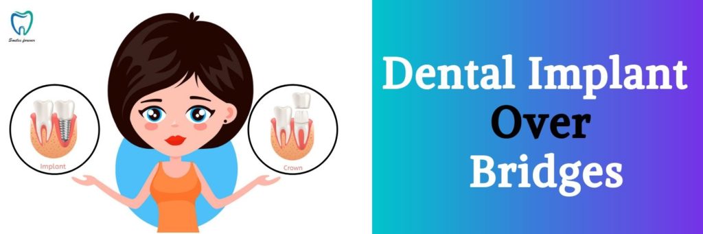 Dental Implant over Bridges | Best Dental Treatments in Bangalore 