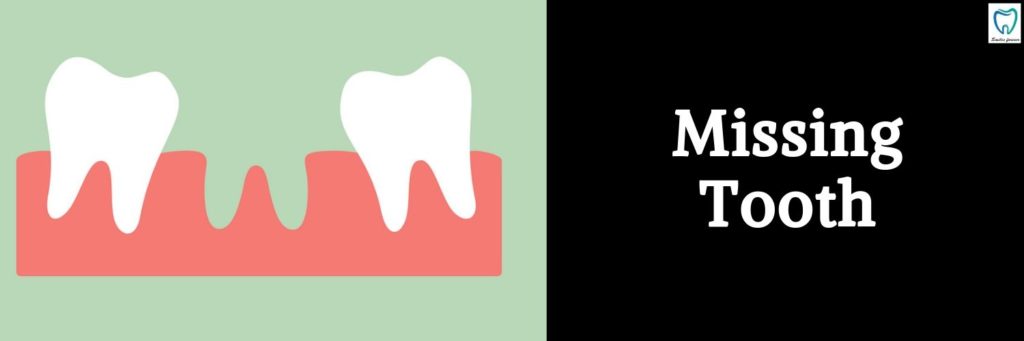 Missing tooth | Best Dental Treatments in Bangalore