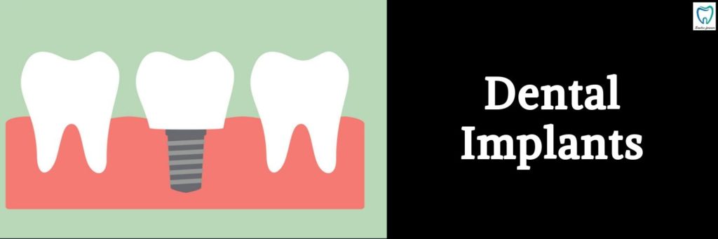 Dental Implants | Best Dental Treatments in Bangalore