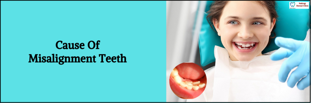 Cause Of Misalignment Teeth | Best Pediatric Dentist in Bellandur