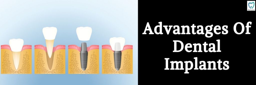 Advantages Dental Implants | Best Dental Treatments in Bangalore
