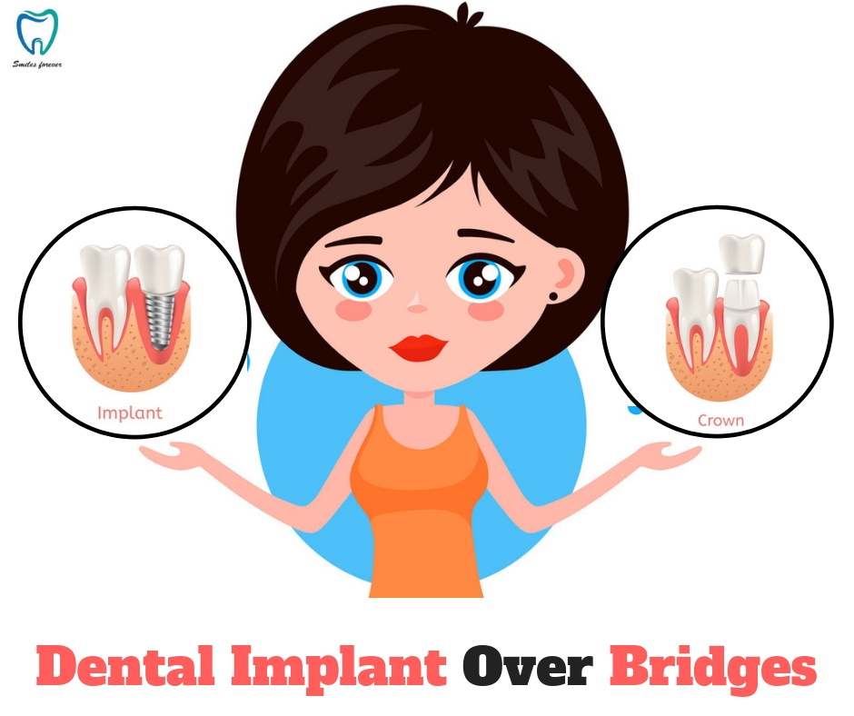 Dental Implant Over Bridges