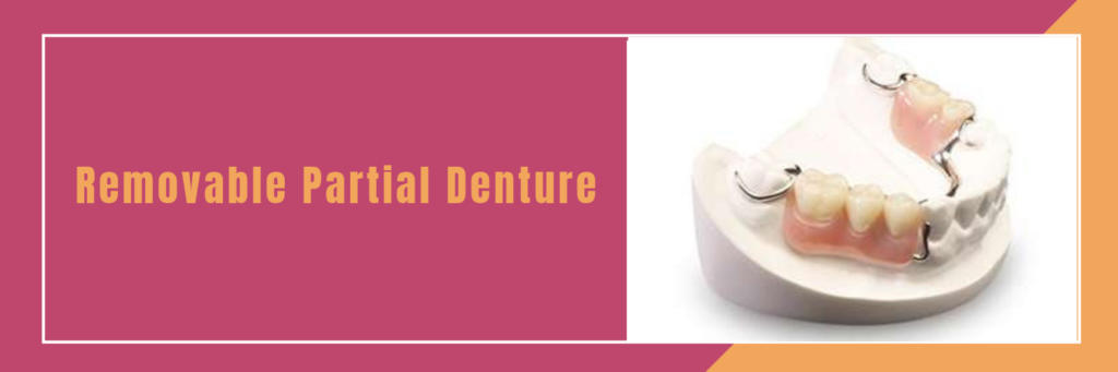 Removable Partial Denture | Dental Implant Treatment in Bangalore