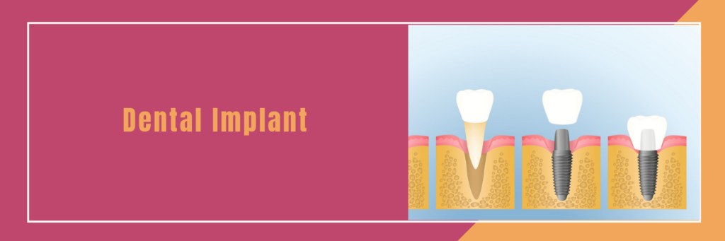Dental Implant | Dental Implant Treatment in Bangalore