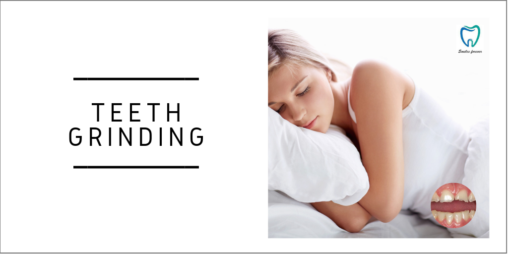Teeth Grinding | Best Dental Care in Bellandur 
