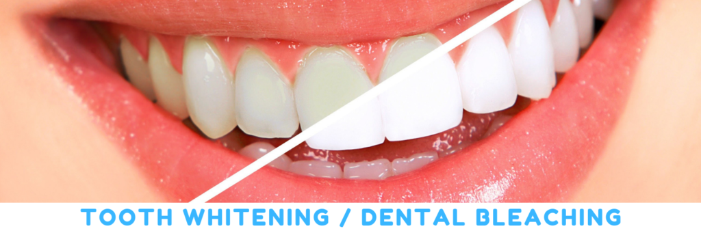 Dental Bleaching | Tooth Whitening Treatment in Bellandur, Bangalore