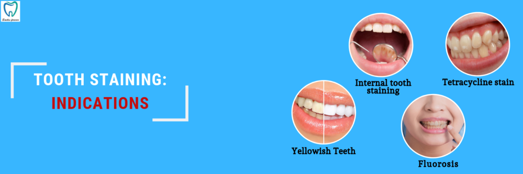 Tooth Stain Indications | Tooth Whitening Treatment in Bellandur, Bangalore