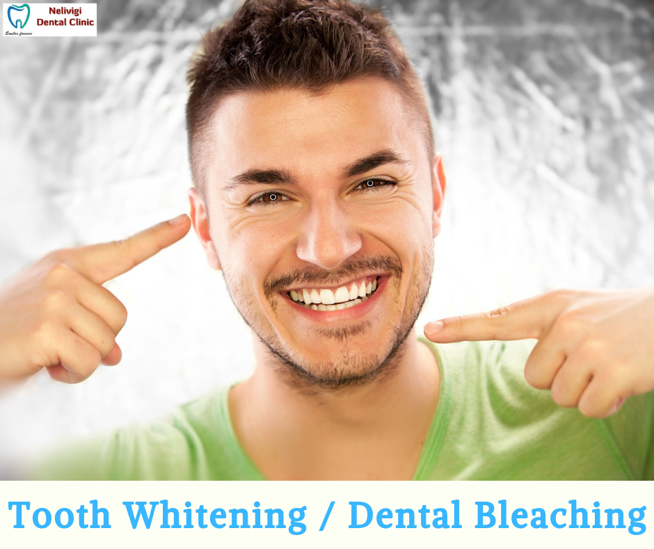 Tooth Whitening or Dental Bleaching