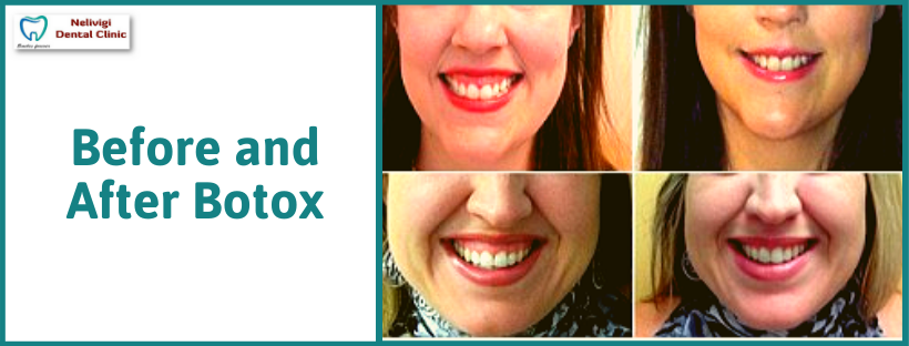 Before and After Botox | Dental Treatment in Bellandur, Bangalore