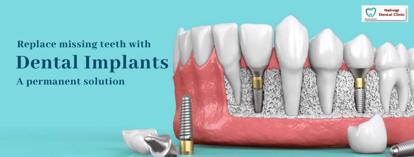 Implants | Best Dental Implant Centre in Bangalore